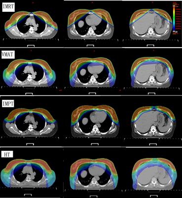 Heart and Cardiac Substructure Dose Sparing in Synchronous Bilateral Breast Radiotherapy: A <mark class="highlighted">Dosimetric Study</mark> of Proton and Photon Radiation Therapy